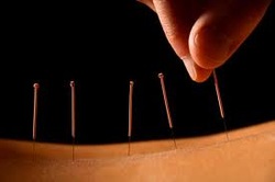 Acupuncture — original practice image